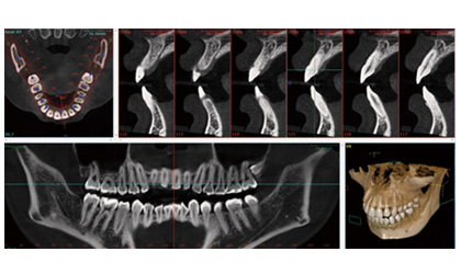 歯科用CTを完備しています